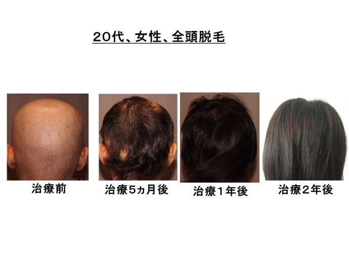 円形脱毛症　病院
